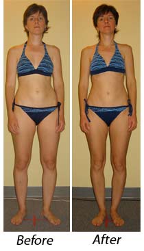 Scoliosis Relief from Rolfing